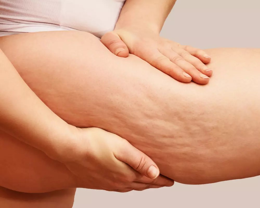 cellulite-cose-come-affrontarla